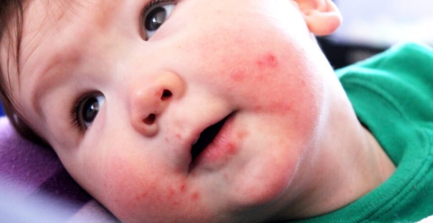 الأطعمة الممنوعة لمرضى الهربس