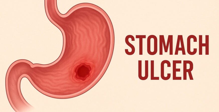 أعراض قرحة المعدة