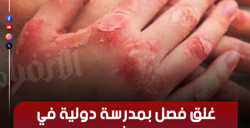 فيروس اليد والفم والقدم HFMD